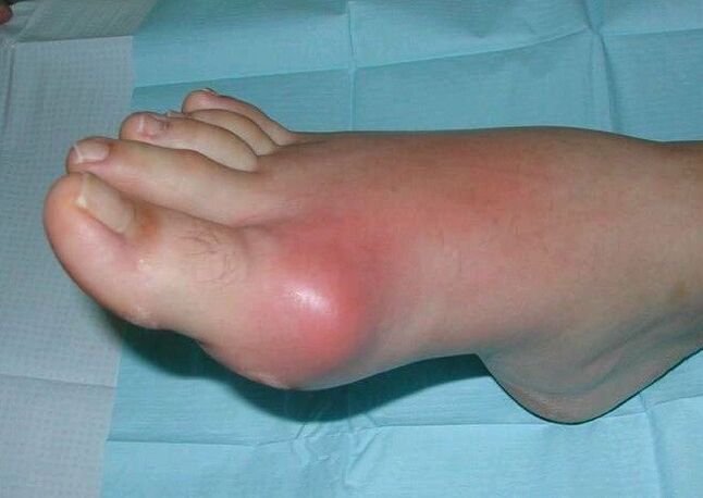 Cadro clínico da artrite do pé inchazo e inflamación