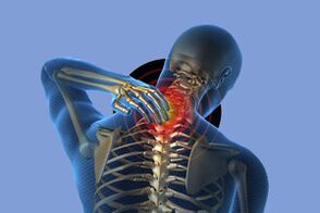 Síntomas da osteocondrose cervical
