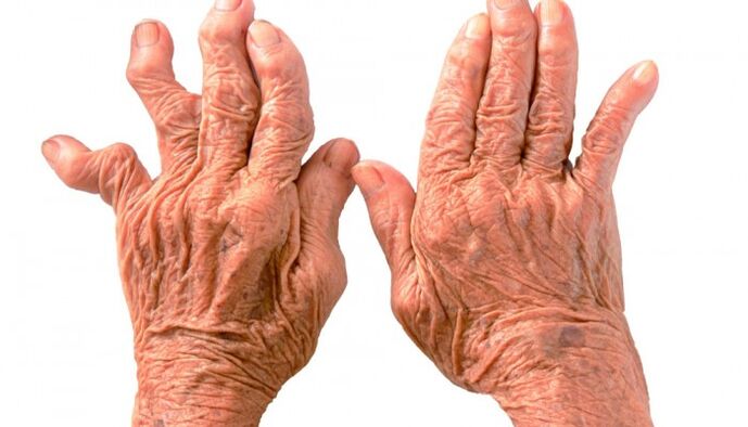 artrite reumatoide como causa de dor nas articulacións dos dedos