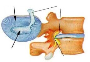 Destrución do anel fibroso na osteocondrose cervical