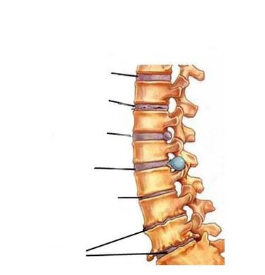 Etapas do desenvolvemento da osteocondrose