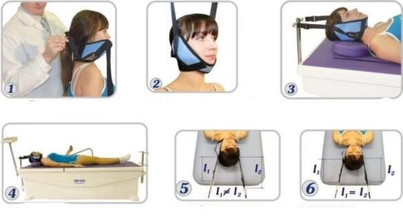 Tratamento da osteocondrose cervical mediante tracción