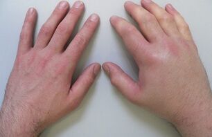 A artralxia como causa de dor nas articulacións dos dedos