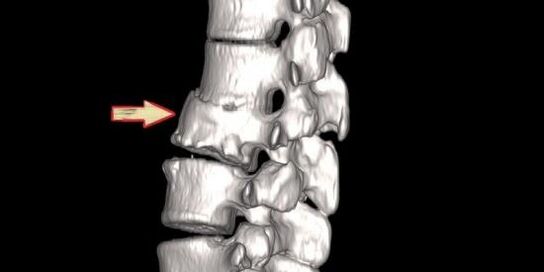Patoloxía espinal como causa de dores nas costas