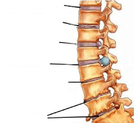 Fases do desenvolvemento da osteocondrose da columna vertebral