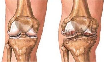 Osteoartrite do xeonllo