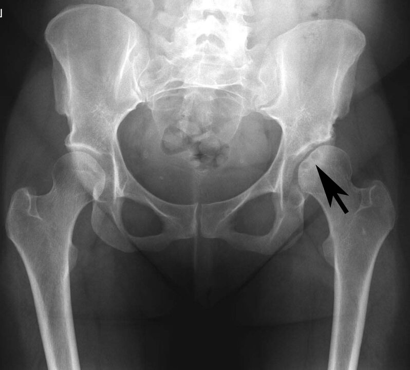Deposición de sales de calcio na articulación da cadeira con pseudogota na radiografía